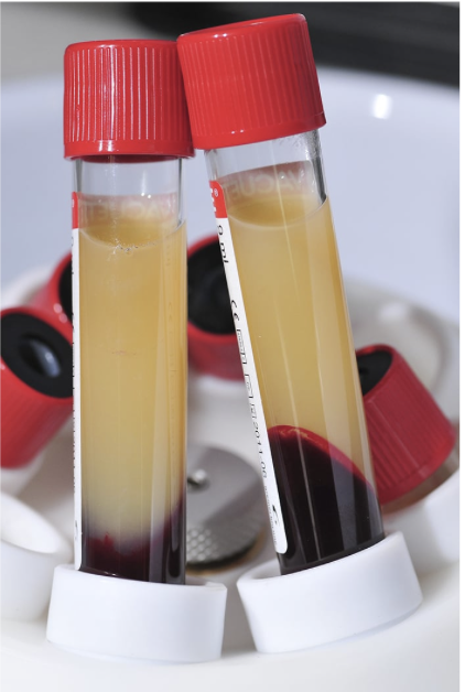 2 tubes containing Platelet-Rich Plasma.