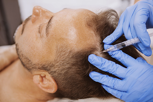 PRP injection into the scalp.